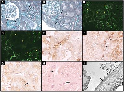 Case report: Isolated tubular basement membrane deposits in a patient with systemic lupus erythematosus - A diagnostic challenge